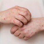 Sarampión en México: Salud confirma la primera muerte en 2026